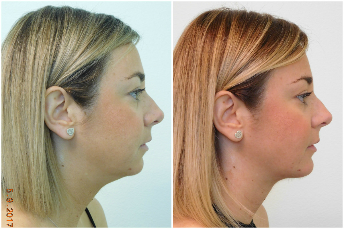 Chin Augmentation Before & After treatment Las Vegas & Henderson, NV
