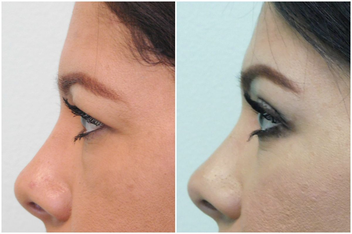 Brow Lift Before & After Henderson, NV