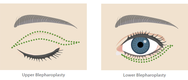 Eyelid-Surgery-Diagram-2 Las Vegas
