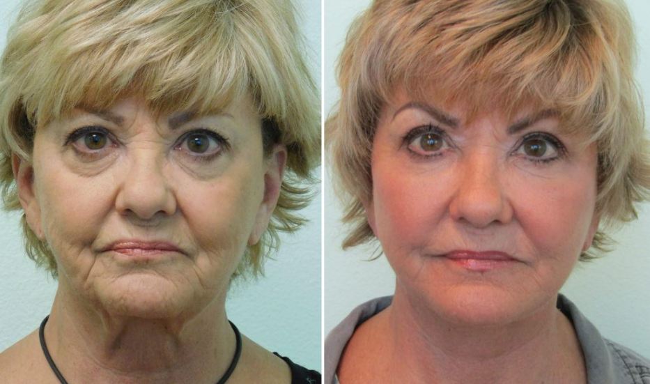 How Much Does a Facelift Cost? Las Vegas Facelift The